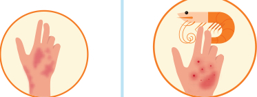 <p>what is urticaria?</p>