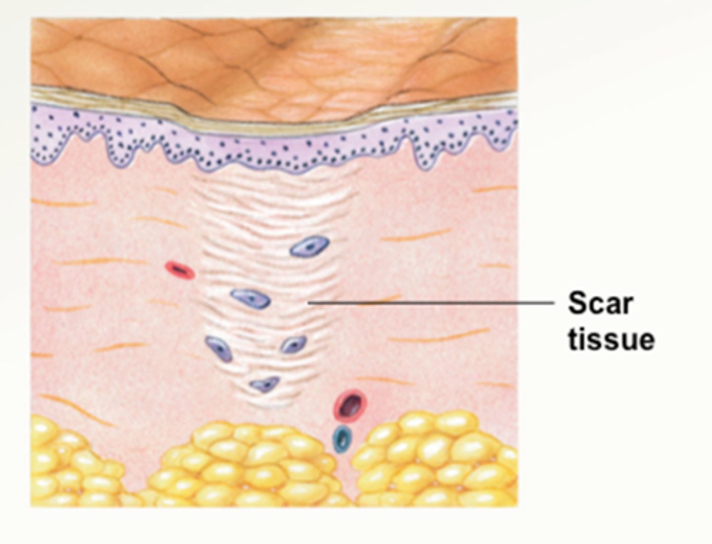 <p>- number of fibroblasts, myofibroblasts, and macrophages is reduced to the preinjury level</p><p>- number of capillaries, the overall vascularity of the area, and water content are reduced</p><p>- proportion of type 1 collagen continues to increase, replacing the existing type 3 collagen and other parts of the collagen lattice</p>
