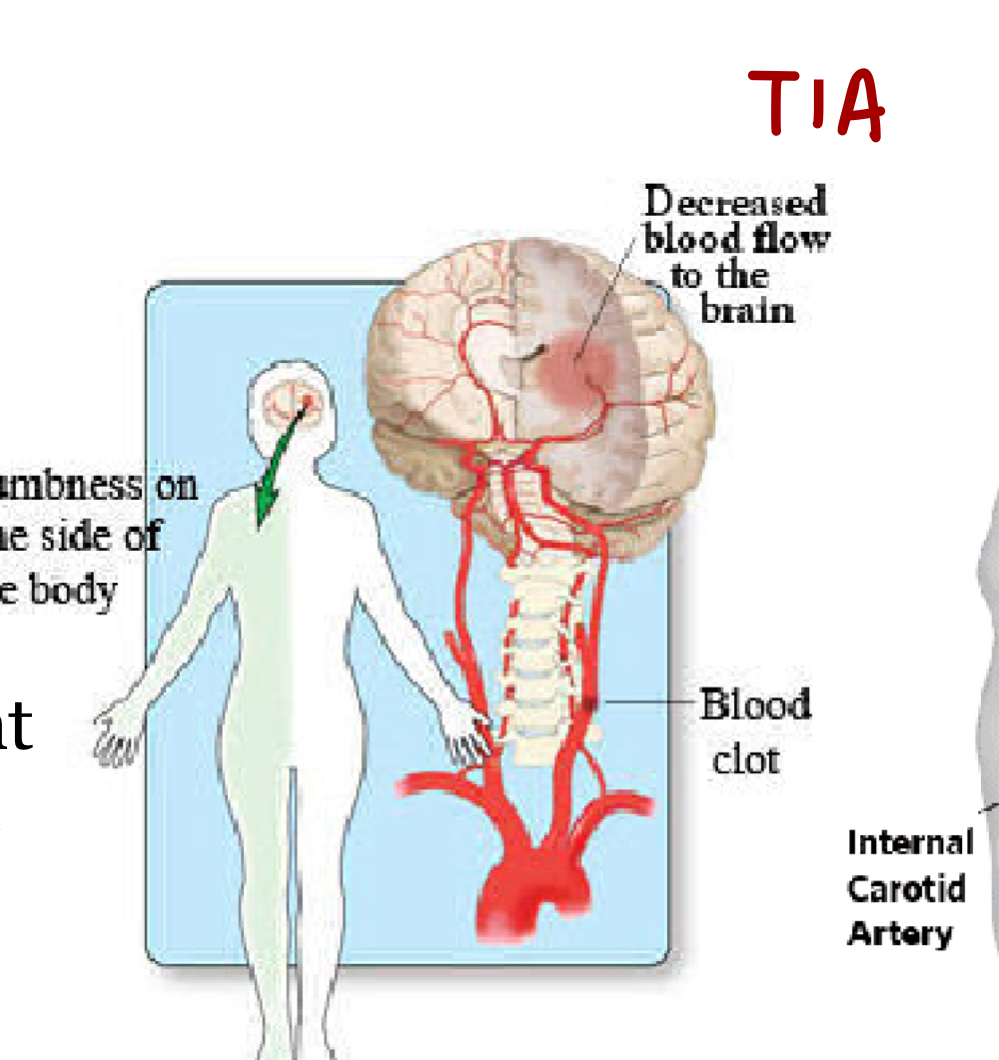 <p>Temporary cerebral dysfunction caused by partially obstructed blood flow.</p>