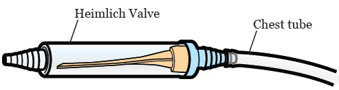 <p>Intermittent OR continuous drainage - Heimlich valve </p>