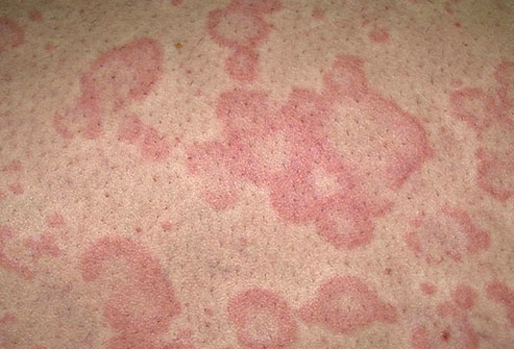 <p>Urticarial Drug Eruption </p>