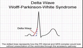 <p><span>Wolff-Parkinson-White (WPW) syndrome is </span>a condition that causes the heart to beat abnormally fast for periods of time.<br><br>delta wave on ecg</p>