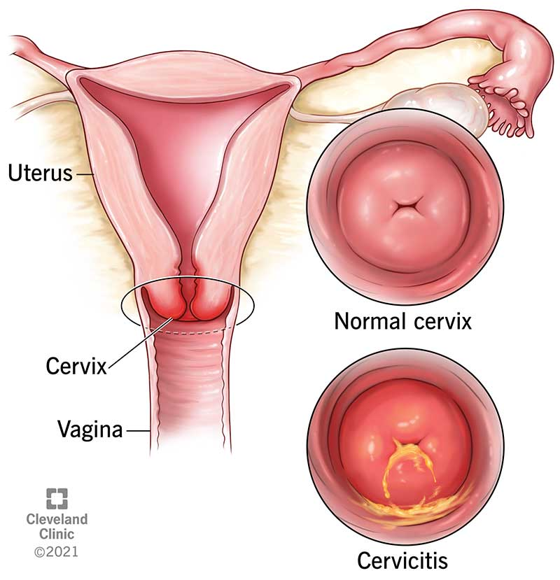<p><span style="color: blue"><strong>narrow lower portion</strong></span> </p><p>→ that <span style="color: green"><strong>opens into vagina</strong></span></p>