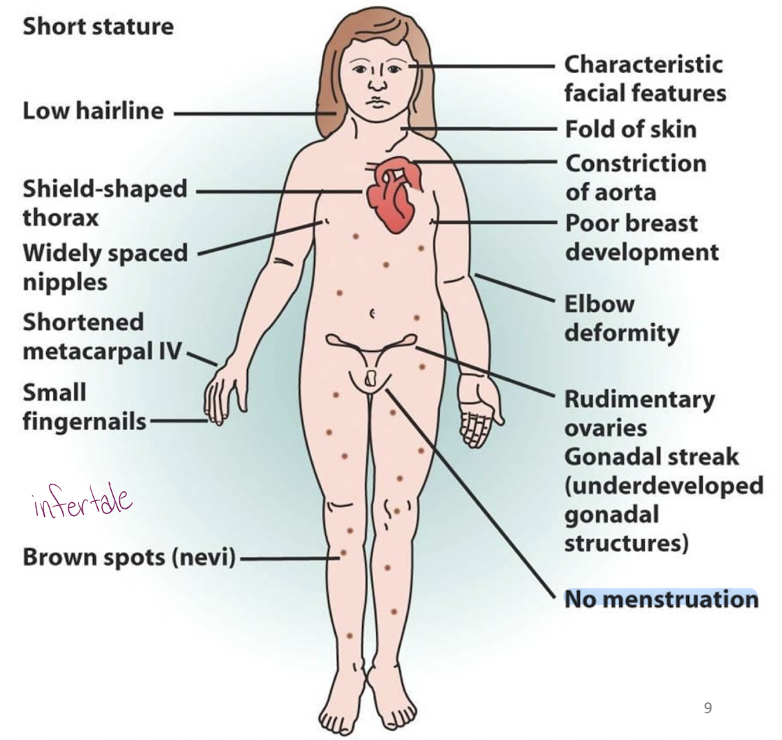 <p>-45, X </p><p>-Only monosomy that is viable</p><p>-Short stature, low hairline, elbow deformity, no menstruations, etc</p>
