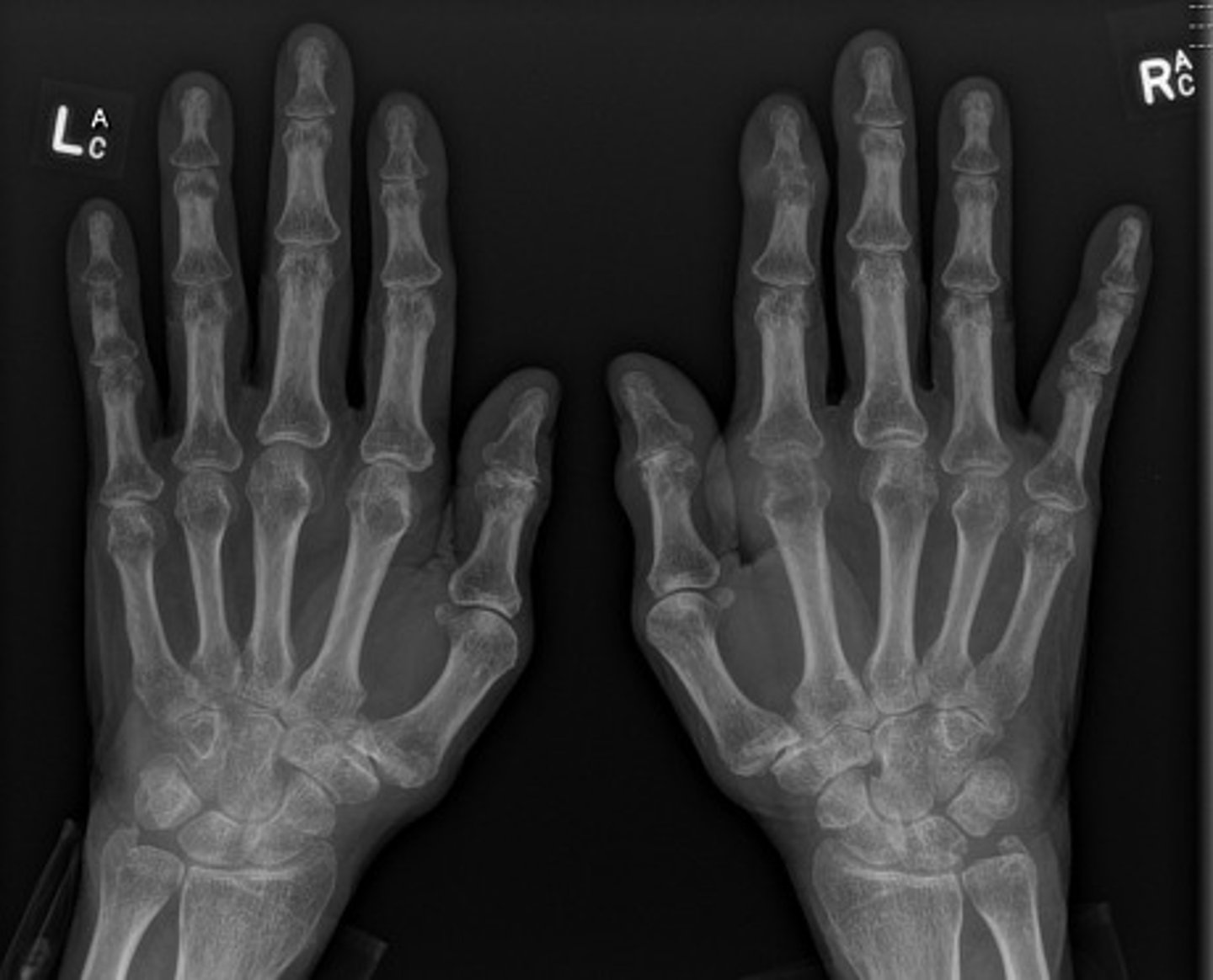 <p>What lab tests can confirm the diagnosis?</p>