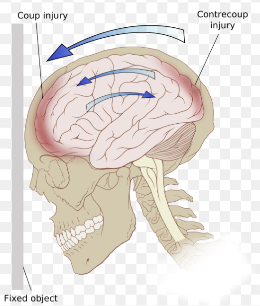 <p>brain is injured at site of impact, then bounces back and hits site opposite from impact → damage on both sides</p>