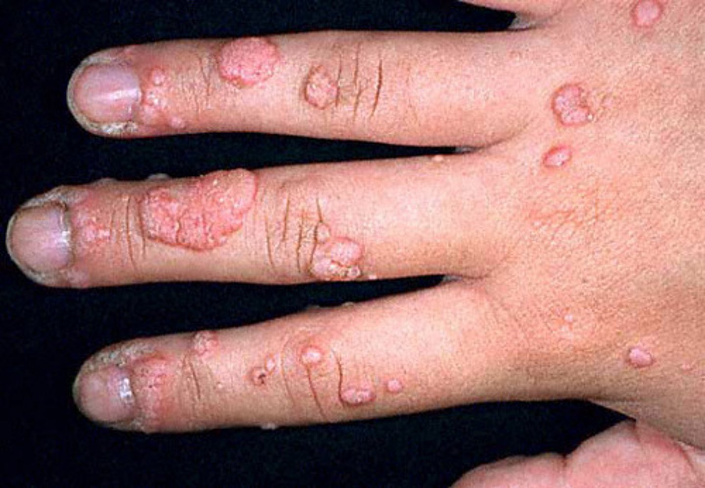 <p>c. Verruca vulgaris</p><p>Caused by HPV, mildly contagious by autoinoculation. Clinical manifestations: circumscribed, hypertrophic, flesh colored Papules limited to epidermis, painful on lateral compression. See Table 25.6 pg 480</p>