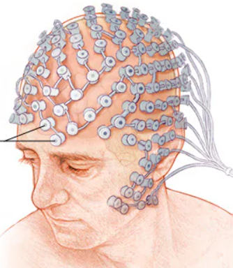 <ul><li><p>an amplified recording of the waves of electrical activity sweeping across the brain’s surface</p></li><li><p>these waves are measured by electrodes placed on the scalp</p></li></ul><p></p>