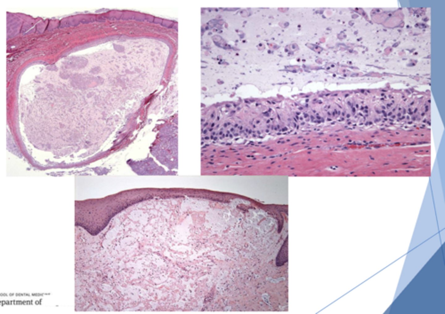 <p>ID the pathology based on the histology findings:</p><p>– Spilled mucin surrounded by granulation tissue</p><p>– Numerous neutrophils + foamy histiocytes/muciphages</p><p>- No epithelial lining</p>