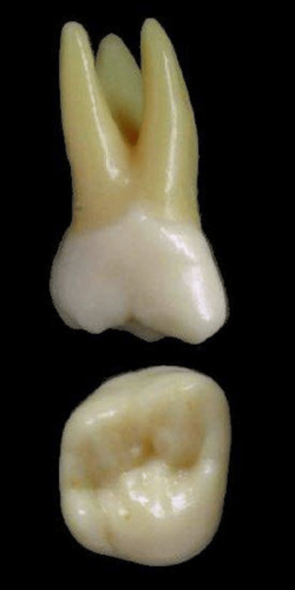<p>what tooth is this &amp; why?</p>