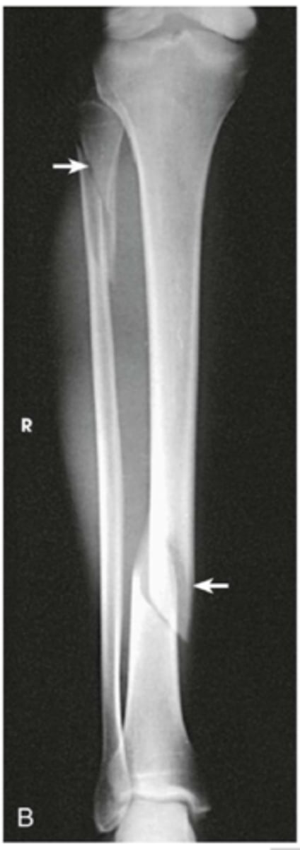 <p>acute (sudden force) => includes:</p><p>- fractures</p><p>- contusions (soft tissue)</p><p>- articulation injuries: strains, sprains, dislocations</p><p>*note: in peds, a strain or sprain force can cause a fracture</p>
