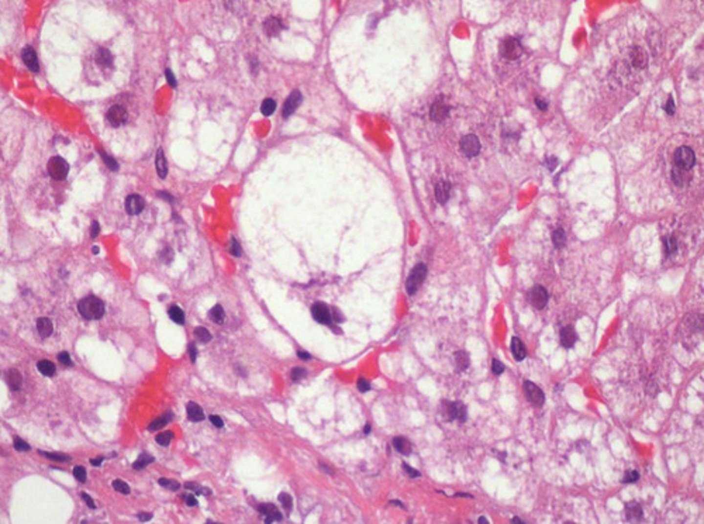 <p>Cells need oxygen to efficiently produce ATP (via aerobic pathway)</p><p>Hypoxia (lack of o2 in cells) leads to decreased ETC&lt; which leads to decreased ATP.</p><p>This causes calcium and sodium to accumulate in the cell, leading to cellular swelling as more water is being drawn into the cell. This causes the cell to be more permeable, amplifying the swelling until the cell dies</p>