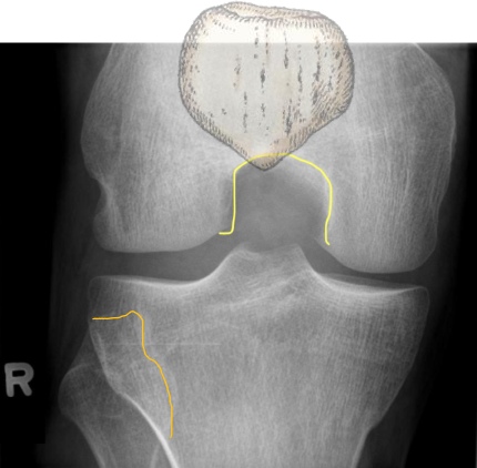 <p>no rotation</p><ul><li><p>MAIN: </p><ul><li><p>med and lat surfaces of the intercondylar fossa in profile</p></li><li><p>femoral condyles symmetrical </p></li></ul></li><li><p>SUPPORTING: ½ fib head SI</p></li></ul><p></p>