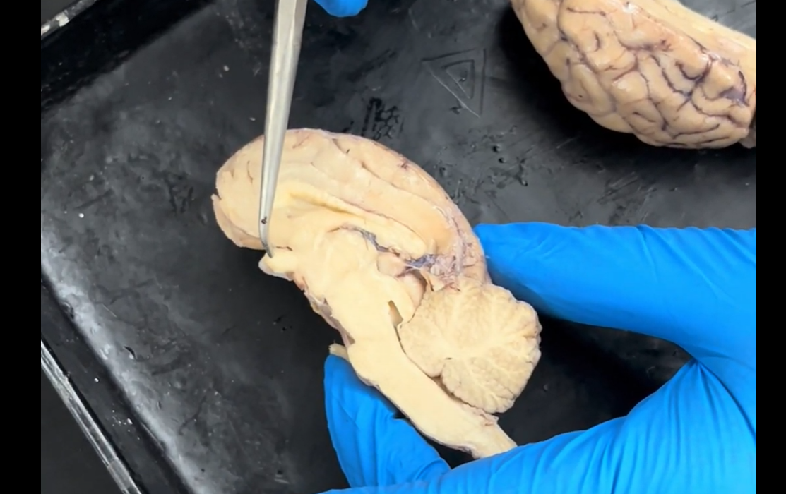 <p>Name the part of the brain the tip of the probe is pointing to.</p>