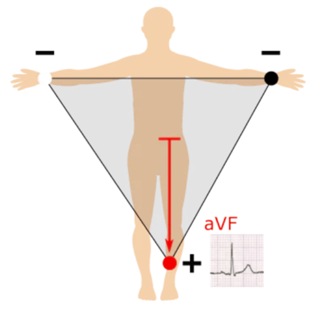 <p>Top --> left leg; produces a positive waveform as heart's electrical activity naturally moves down &amp; to the left</p>