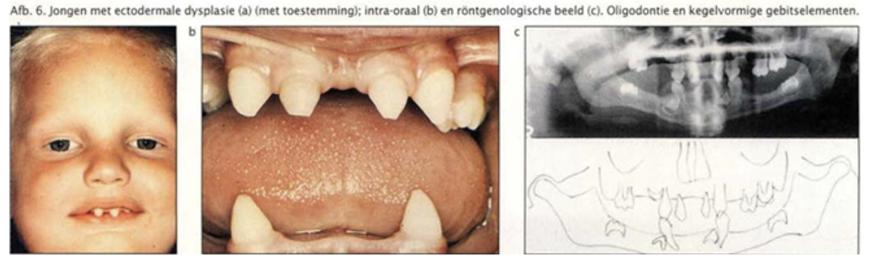 <p>Bij ectodermale dysplasie bestaat uit hypo- of aplasie van ectodermale structuren, zoals haar, gebitselementen en oppervlakkige klieren. In de meeste gevallen is de overerving X-gebonden recessief. Persisterende koorts op kinderleeftijd wordt veroorzaakt door een inadequate warmteregulatie en afwezigheid van zweetproductie. De huid is dun en droog. De patiënten hebben fijn, dun blond haar maar de nagels zijn relatief normaal. De functie van de speeksel-, traan- en slijmklieren is vaak verminderd en de gebitselementen zijn niet gevormd of kegelvormig en klein.</p>