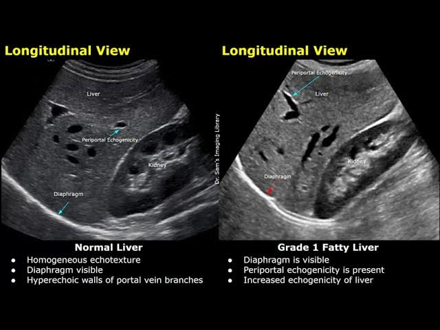 <p>Fatty liver should be charted as echogenic liver. Difficult to penetrate. Consistent with Fatty liver.</p>