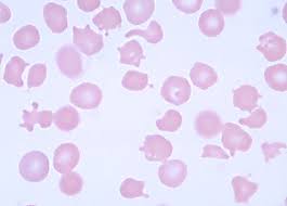 <p>Variation in shape of RBC’s</p>
