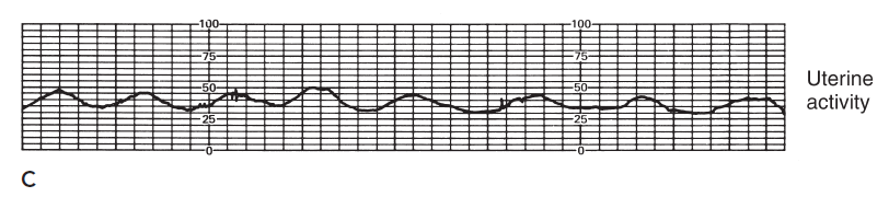 <p>Hypertonic uterine contractions</p>