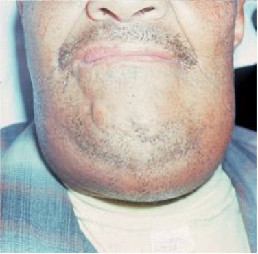 <p>edema/erythema of upper neck under chin and floor of mouth, hot potato voice, cellulitis</p>