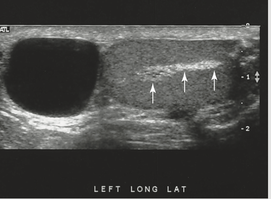 <p>a 40-year old patient presents with palpable left scrotal mass and a previous history of epididymitis. This hyperechoic intratesticular structure is most sus for</p>