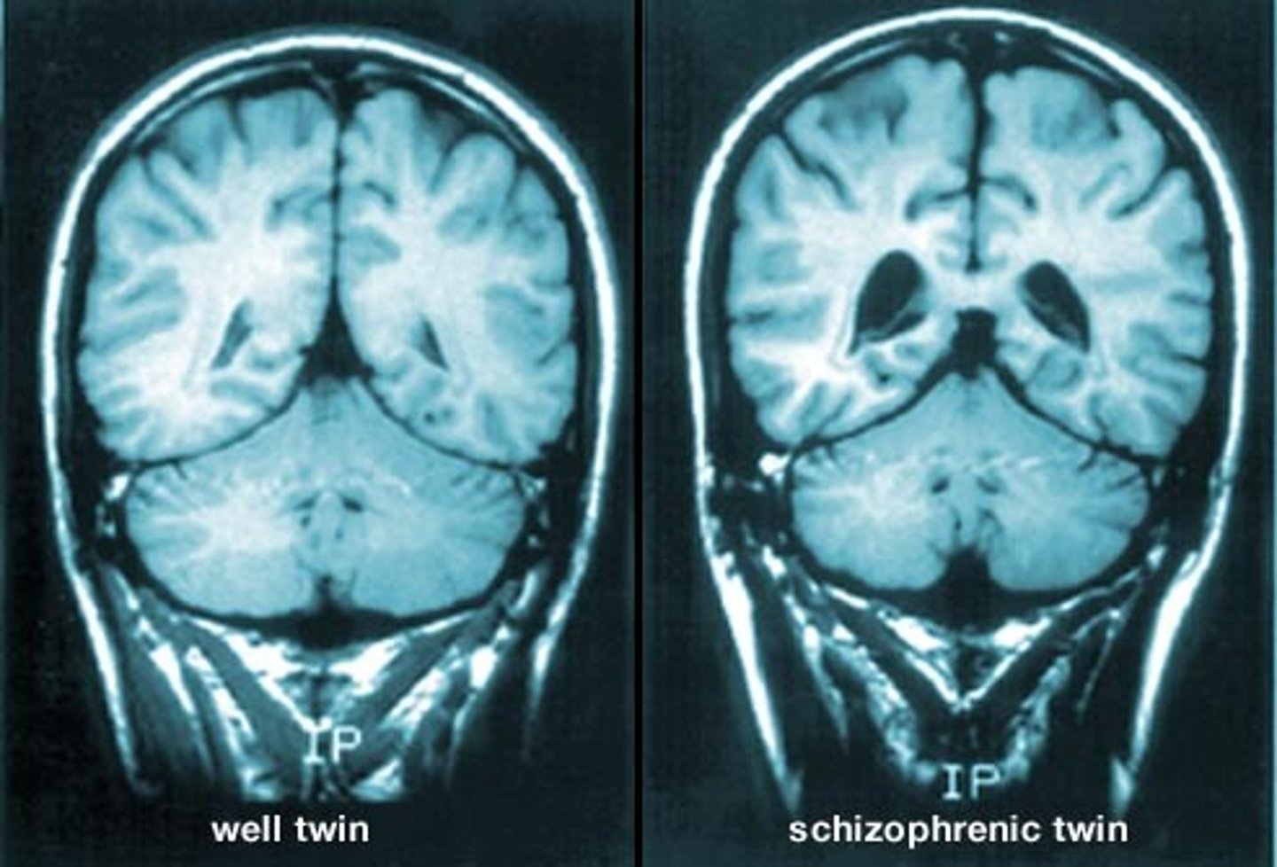 <p>Ventricular size</p><p>Total brain volume</p><p>Grey matter in association cortices</p><p>Asymmetries?</p><p>[Image]</p><p>This shows the enlarged ventricles of a patient with schizophrenia alongside their monozygotic twin. Enlarged ventricles are indicative of reduced grey or white matter in the patient - but the cause of this reduction remains elusive.</p><p>Metabolic imaging also shows changes with a general finding of hypometabolism and in particular hypofrontality.</p>