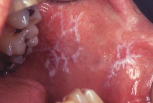 <p>More common, asymptomatic, lace-like (Wickham striae)</p>