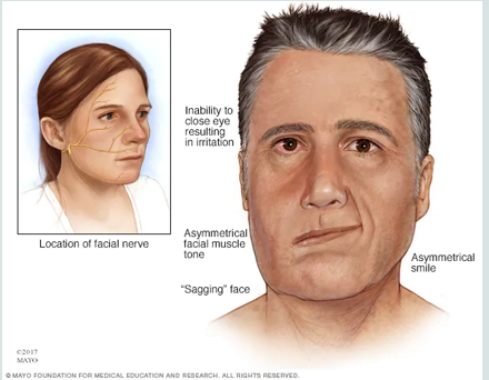 <ul><li><p>causes paralysis or weakness in one side of the face</p></li></ul><p></p>