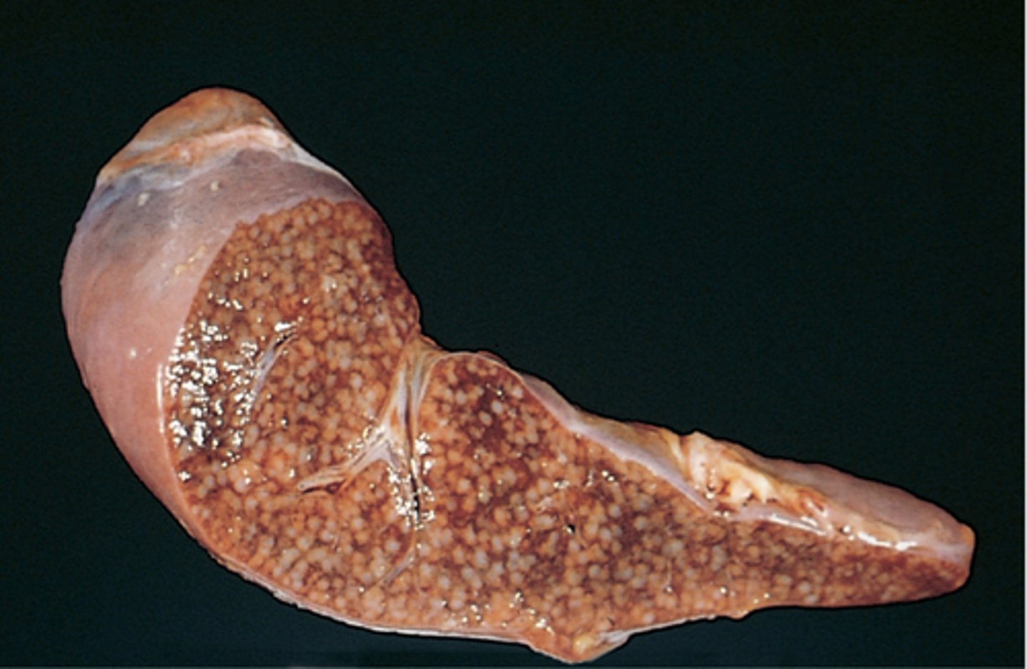 <p>the development of active tubercles throughout the body</p>