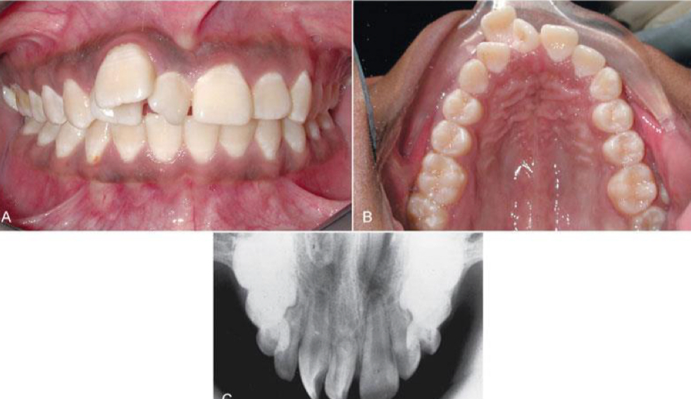 <p><strong>Mesiodens</strong>- between max ci- concern if blocks eruption of permanent incisors</p><p><strong>Lateral incisors, 2pm, 4m</strong></p><p>If impacted- risk of cyst formation</p>