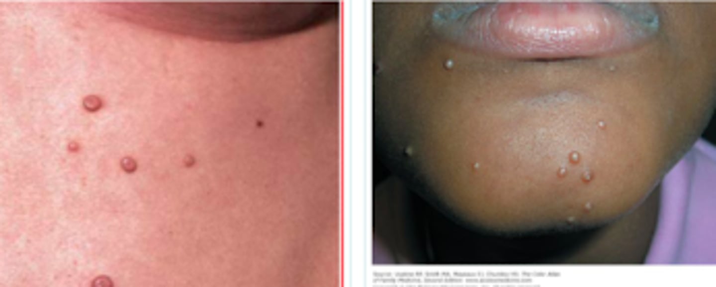 <p>Viral Skin Infections:</p><p>If a pt presented w the following S/S, what may we suspect they have:</p><p>- history of wrestling (skin-to-skin contact)</p><p>- <strong>asymptomatic</strong>, but interesting skin findings</p><p>- <strong>pearly white or skin-colored papules/nodules that are round &amp; umbilicated</strong></p><p>- larger lesions have a central necrotic plug</p>
