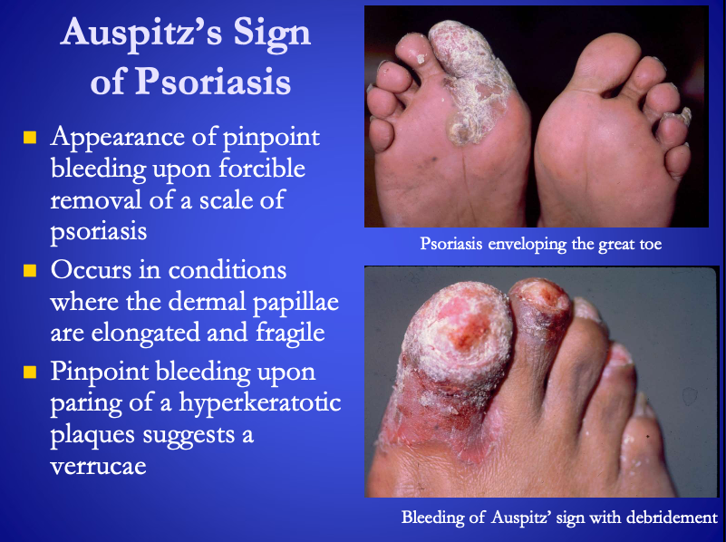 <p><span><strong>[...]</strong></span> of Psoriasis</p><ul><li><p><strong>Pinpoint bleeding </strong>upon forcible removal of a scale of psoriasis</p></li><li><p>Psoriasis is a skin disorder that causes skin cells to multiply up to 10 times faster than normal</p></li></ul><p></p>