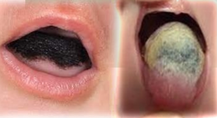 <p><strong><u>Hairy tongue</u></strong></p><p class="has-focus">Associated with cigarettes, poor oral hygeine, antibiotics, dry mouth, overuse of mouth rinses.</p><p class="has-focus">Coated tongue more common in children</p><p class="has-focus"></p><p class="has-focus is-empty"><strong>Treatment </strong>- Eliminate cause, Brush tongue</p><p class="has-focus"></p><p class="has-focus is-empty"><em>DD - Coated tongue, Frictional keratosis, Hyperplastic candidiasis</em></p>