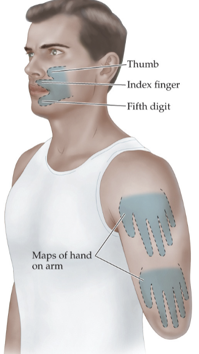 <p>the hand is normally flanked below by face representation and above by upper arm representation in the cortical homunculus - following amputation face and arm regions take over hand region of cortex → touching of face and upper arm = pain in missing hand</p>