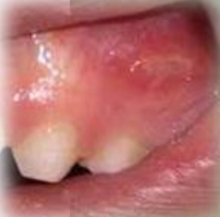 <p>Painful recurrent ulcers. Can be 1-5 superficial and <1cm or multiple deep >1cm. Can also be herpetiform.</p><p>First and second decade</p><p>Female prediliction</p><p class="has-focus"><strong>Found on:</strong></p><p class="has-focus">Buccal, labial mucosa most common</p><p class="has-focus">Non keratinized mucosa</p>