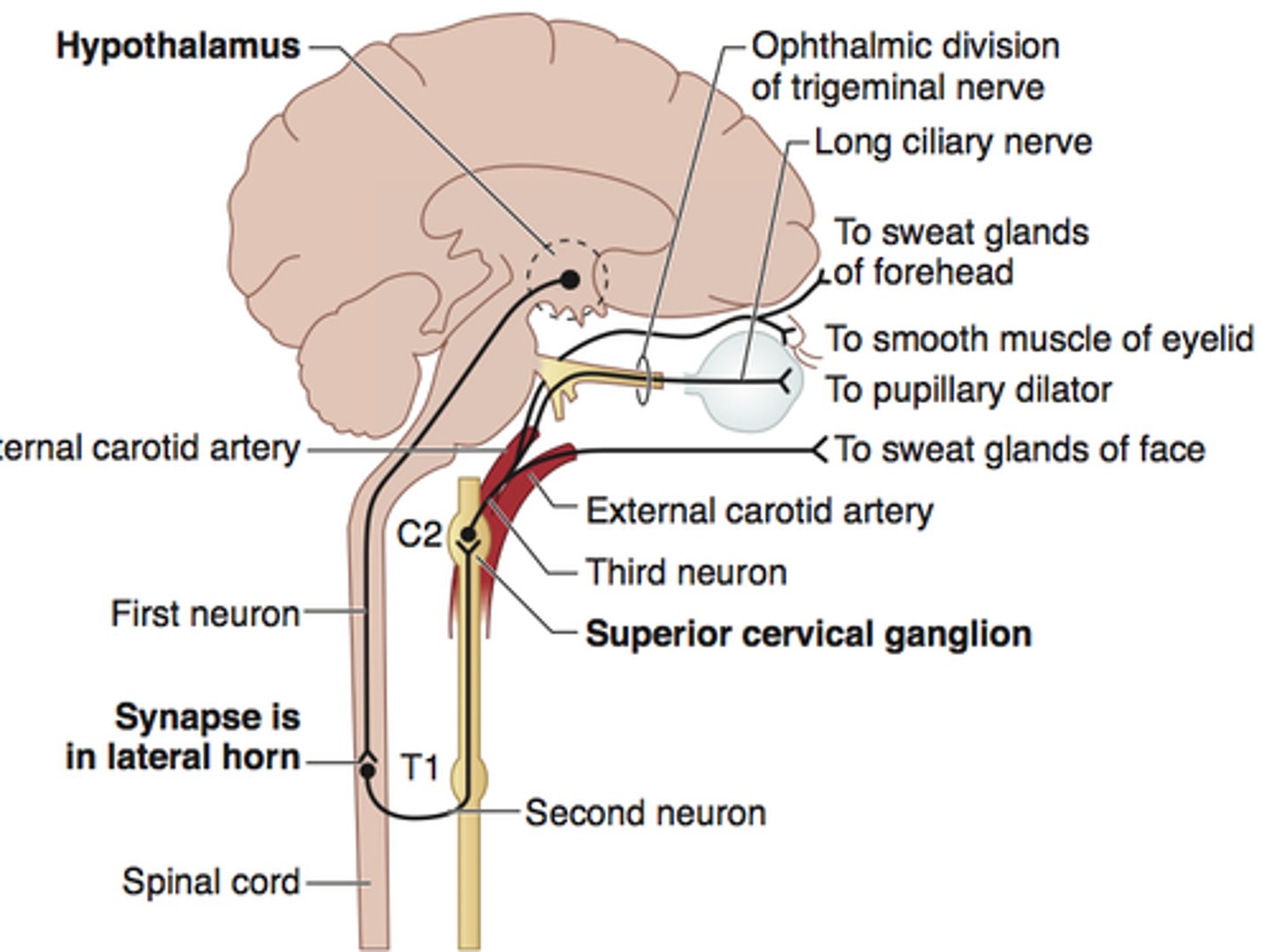 <p>Horner syndrome (sympathetic chain lesion)</p>