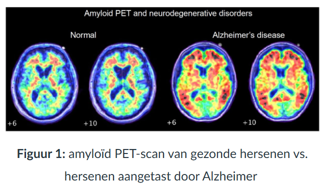 <ul><li><p>Een <strong>PET-scan (Positron Emissie Tomografie)</strong> is een <strong>functionele beeldvormingstechniek</strong> die de activiteit van organen of weefsels toont.</p></li><li><p>Het is een <strong>nucleaire beeldvormingstechniek</strong> die vooral wordt gebruikt om <strong>functionele processen in de hersenen</strong> (zoals stofwisseling) in kaart te brengen.</p></li><li><p>Wordt vaak ingezet voor vroege detectie van <strong>neurologische aandoeningen</strong> zoals de ziekte van <strong>Alzheimer</strong> en <strong>Parkinson</strong>.</p></li></ul><p></p>