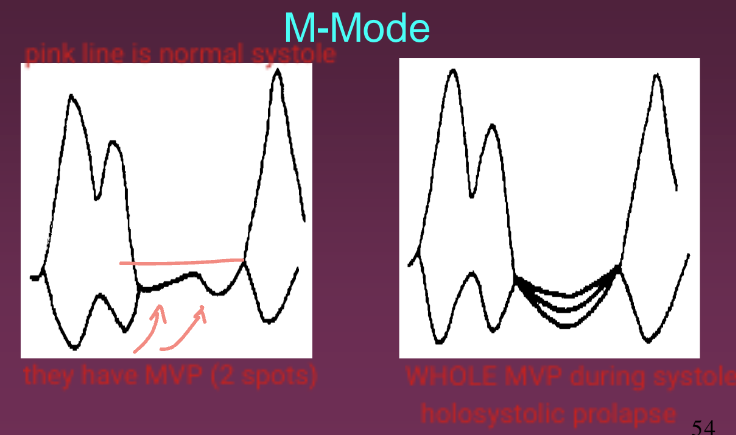 <ul><li><p>MVL dropping 2 mm or more below the C-D line, at mid to late systole (pansystolic)</p></li><li><p>MVL dropping 3 mm or more below the C-D line throughout systole (holosystolic)</p></li></ul>