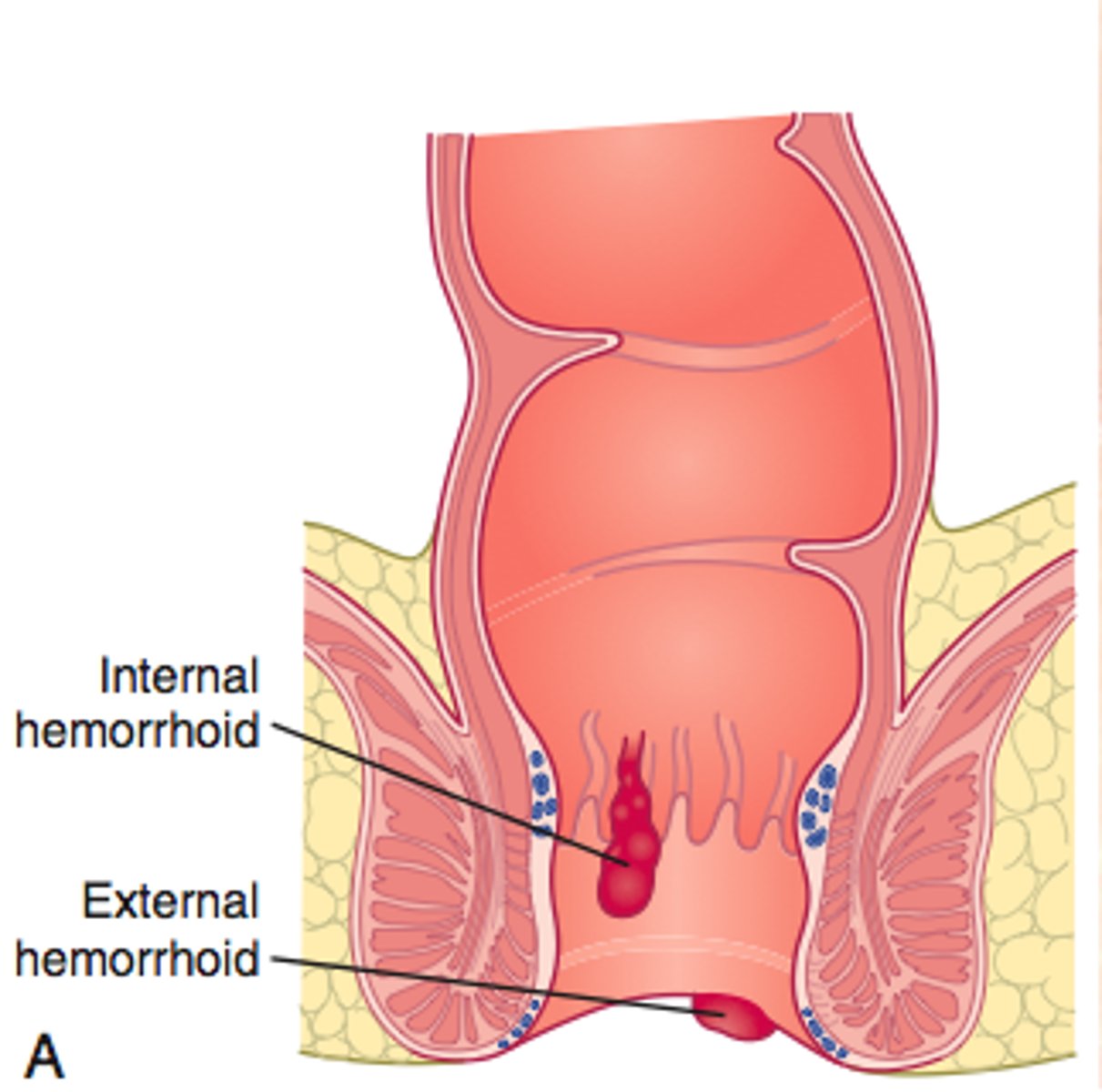 <p>Swollen, painful rectal veins; often a result of constipation</p>