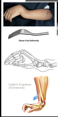 <p>Distal Radius Fracture with <strong>dorsal displacement </strong></p><p>Non-displaced: Sugar tong split </p><p>Displaced: Reduction, Splint </p>