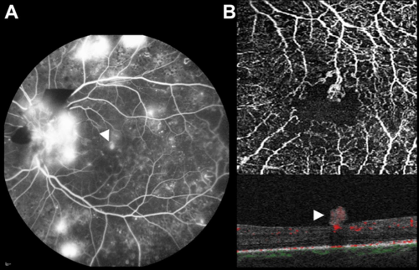 <p>dye permeates out of leaky, incompetent BV = hyperF enlarges throughout angiogram with fuzzy borders</p>