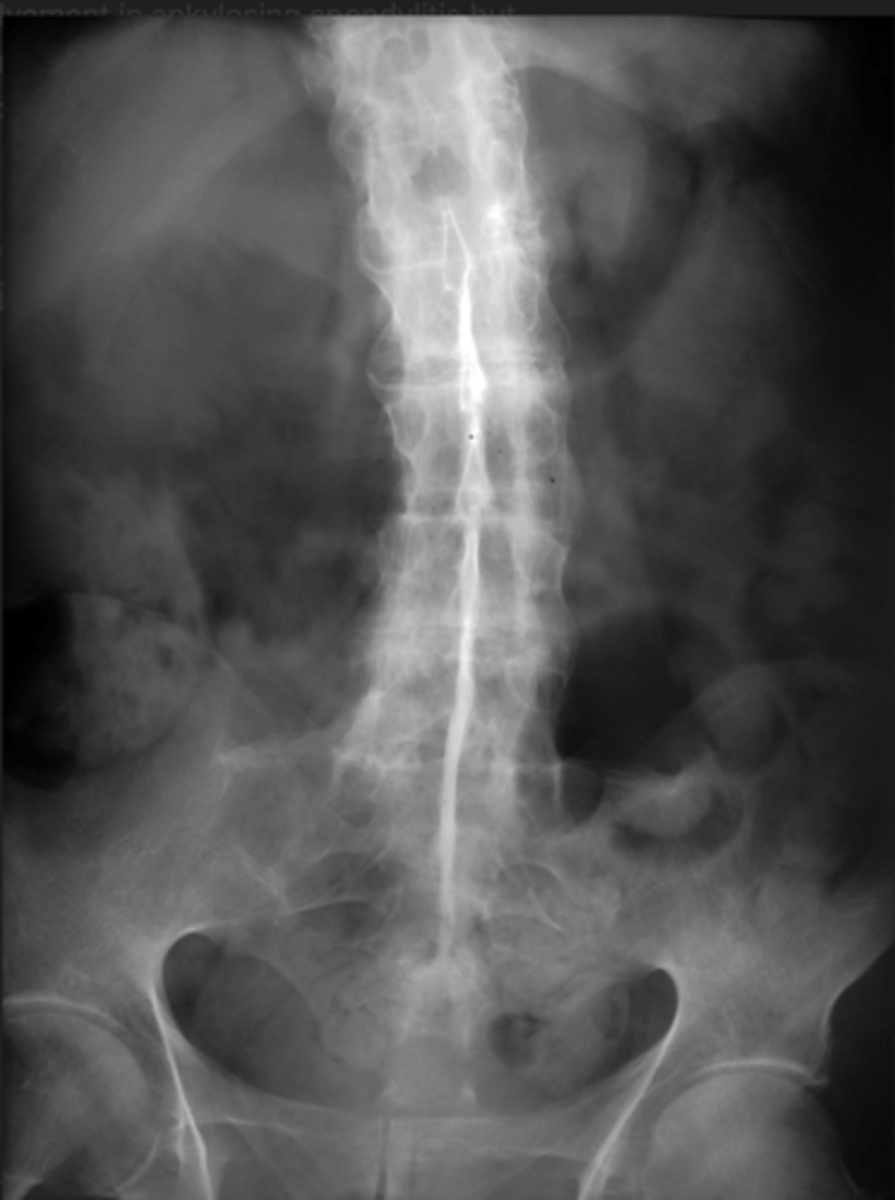 <p>- Bamboo spine with a single central radiodense line related to ossification of supraspinous and interspinous ligaments (shown in picture)</p><p>- fused sacroiliac joint</p><p>- Squaring of vertebrae</p><p>- syndesmophytes (which go above and below the bone)</p><p>- shiny corner sign (triangular areas of sclerosis at the anterior vertebral endplates on X-ray.)</p>