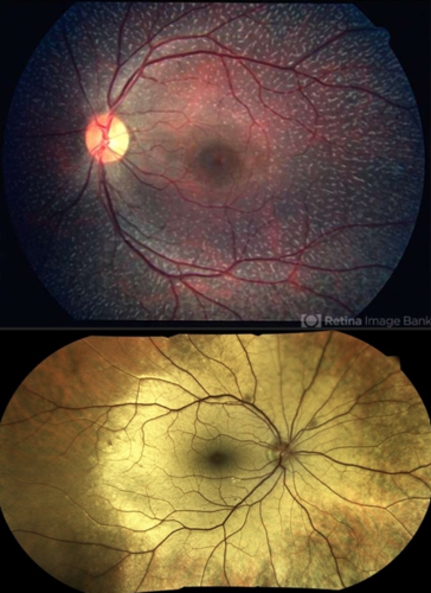 <p>reduced VA (20/40 to 20/60)</p><p>photophobia</p><p>myopia</p><p>strabismus</p><p>nystagmus</p>