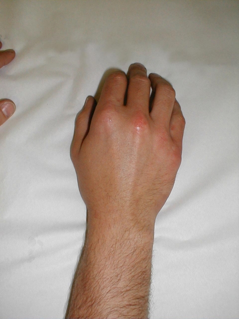 <p>Boxer’s Fracture</p>