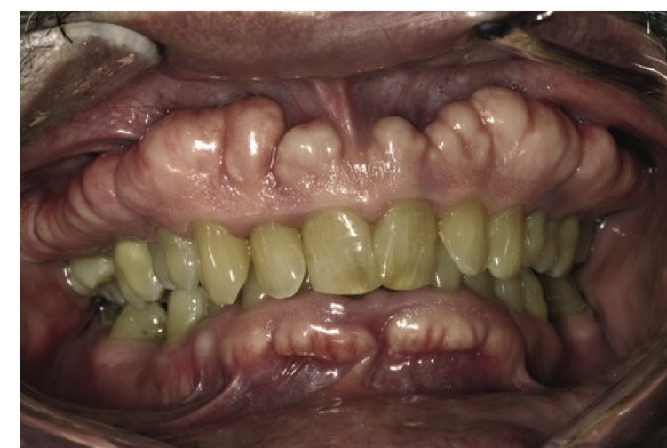 <ul><li><p class="p1">More frequent in adults</p></li></ul><ul><li><p class="p1"><strong>Buccal exostoses:</strong></p><ul><li><p class="p1">Bilateral row of bony nodules</p></li><li><p class="p1">Located on facial aspect of maxillary and/or mandibular alveolar ridge</p></li></ul></li><li><p class="p1"><strong>Symptoms:</strong></p><ul><li><p class="p1">Usually <strong>asymptomatic</strong></p></li><li><p class="p1">Surface mucosa may ulcerate </p></li></ul></li></ul><p></p>