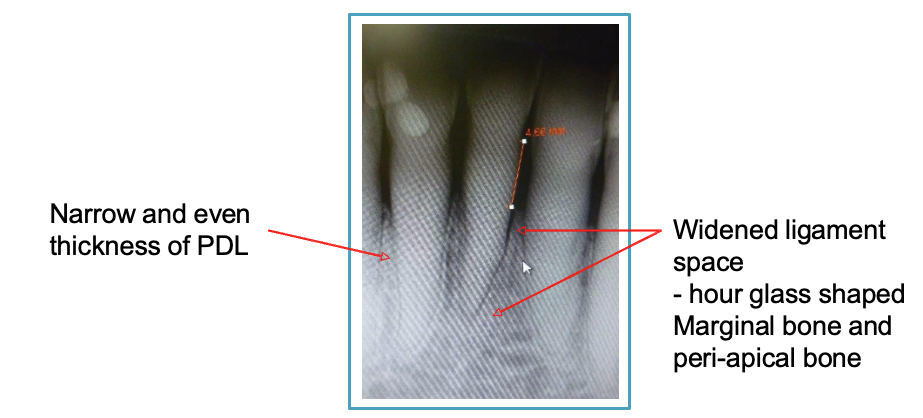 <ul><li><p>narrow + even thickness of PDL</p></li><li><p>widened ligament space: hour glass shape of marginal + peri-apical bone </p></li></ul><p></p>
