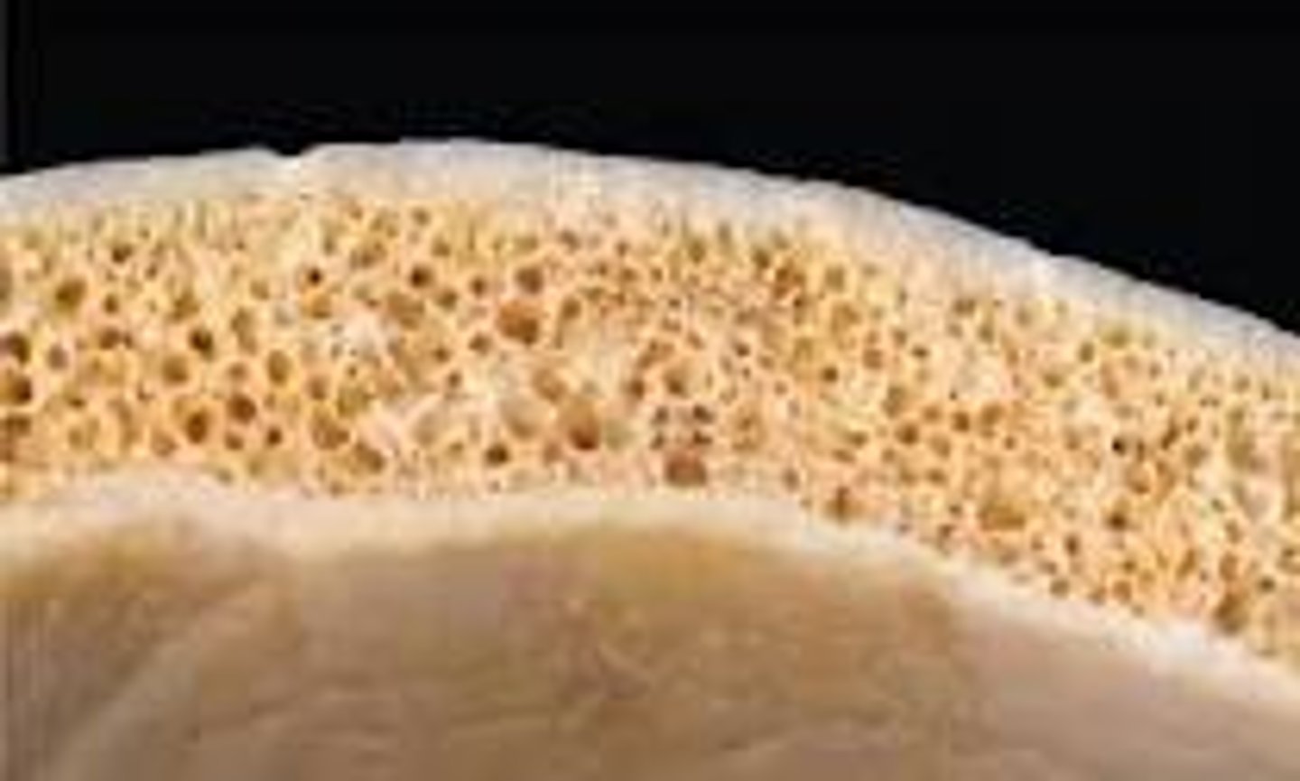 <p>spongy bone between the external and internal tables in a flat bone that is filled with red marrow</p>
