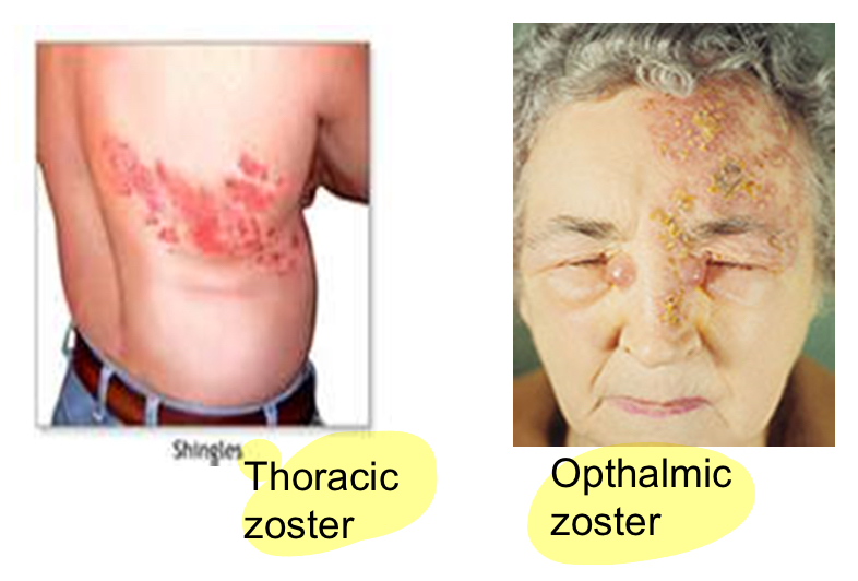 <p><span><strong>Varicella Zoster/shingles Virus-Chickenpox</strong></span></p>