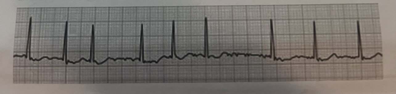 <p>Atrial Fibrillation (A-Fib)</p>