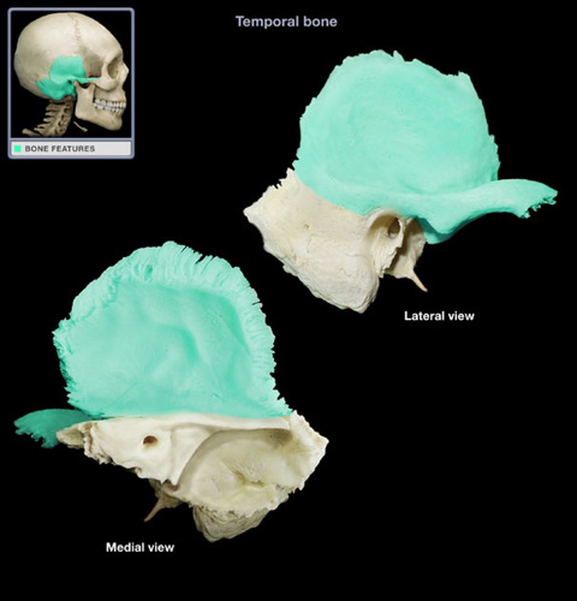 <p>Paired bones forming most of lateral base and sides of brain case</p><p>Each bone has 3 parts</p><p>- Squamous part</p><p>- Includes zygomatic process</p><p>- Petrous part</p><p>- Tympanic part</p><p>- Includes styloid process</p>